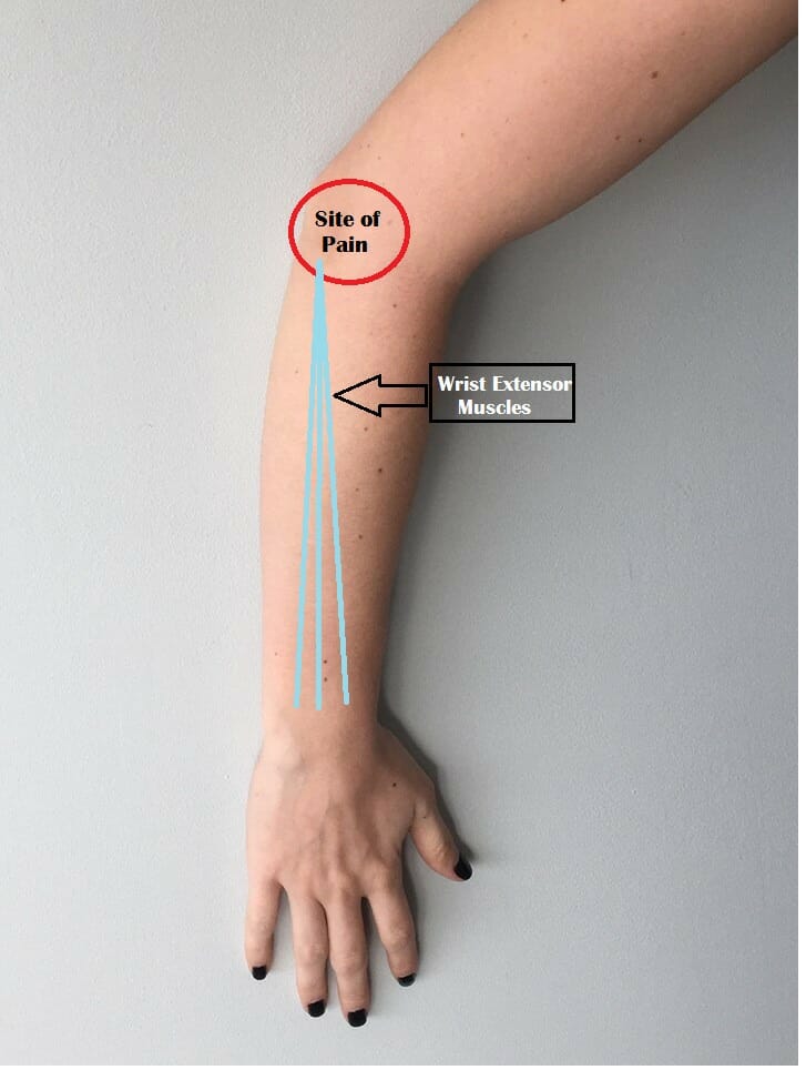 Tennis Elbow Wrist Extensor Muscles