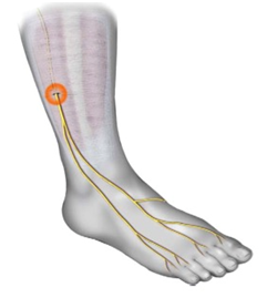 Acupuncture points for ankle sprains by Dr Jenn in Oakville ankle pain treatment acupuncture oakville where it hurts and what to do