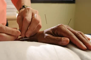 acupuncture needles in a patients hand and wrist
